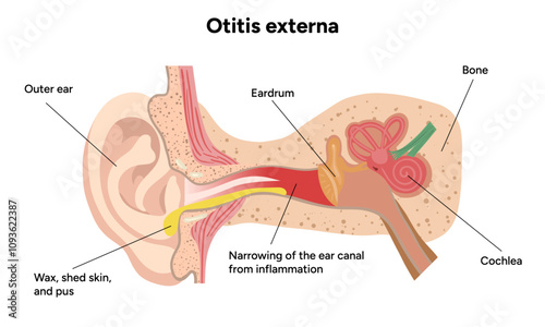 Otitis externa anatomy ear disease inflammation 