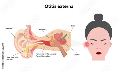 Otitis externa anatomy ear disease inflammation 