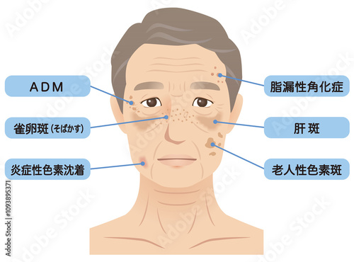 Billede på lærred 高齢男性の顔　シミ　名称　美容　老化