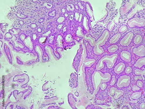 Human cell tissue under microscope in pathology laboratory. Microscopic picture of chronic gastric disease photo