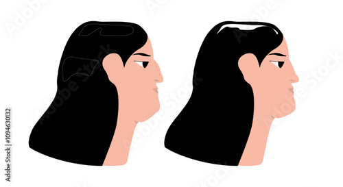 Rhinoplasty, plastic surgery before and after. Woman patient profile, nose reshaping and cosmetic aesthetic enhancement, modification, correction. Flat vector illustration isolated on white background