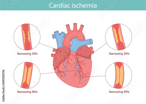 cardiac ischemia. anatomical illustration drawn in cartoon style