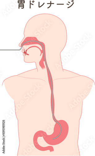 胃ドレナージ、Nasogastric tube