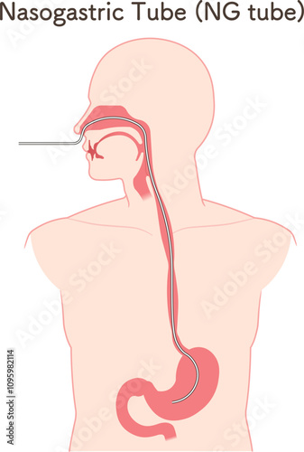 胃ドレナージ、Nasogastric tube