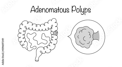 Adenomatous Polyps