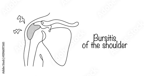 Bursitis of the shoulder