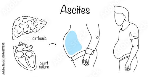 Ascites