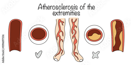 Atherosclerosis of the extremities