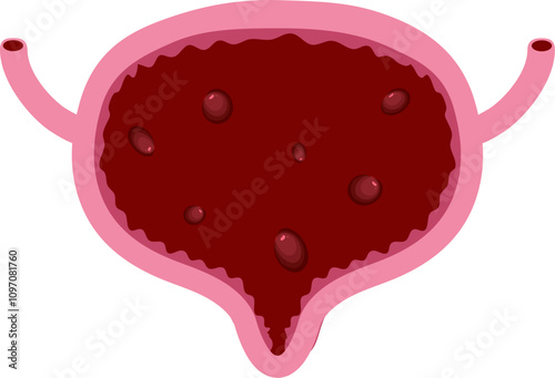 Bladder disease illustration. Urinary tract infection. Bladder cancer. Bladder stones. Bladder inconvenience.