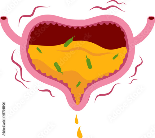 Bladder disease illustration. Urinary tract infection. Bladder cancer. Bladder stones. Bladder inconvenience.