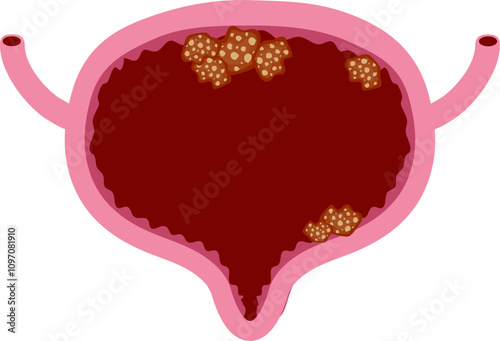 Bladder disease illustration. Urinary tract infection. Bladder cancer. Bladder stones. Bladder inconvenience.