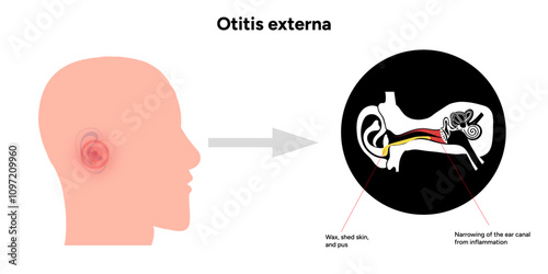 Otitis externa anatomy ear disease inflammation 