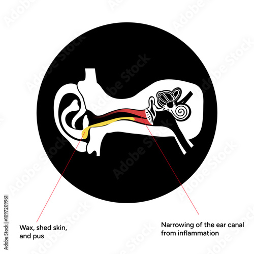 Otitis externa anatomy ear disease inflammation 