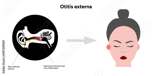 Otitis externa anatomy ear disease inflammation 