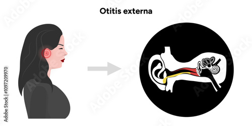 Otitis externa anatomy ear disease inflammation 