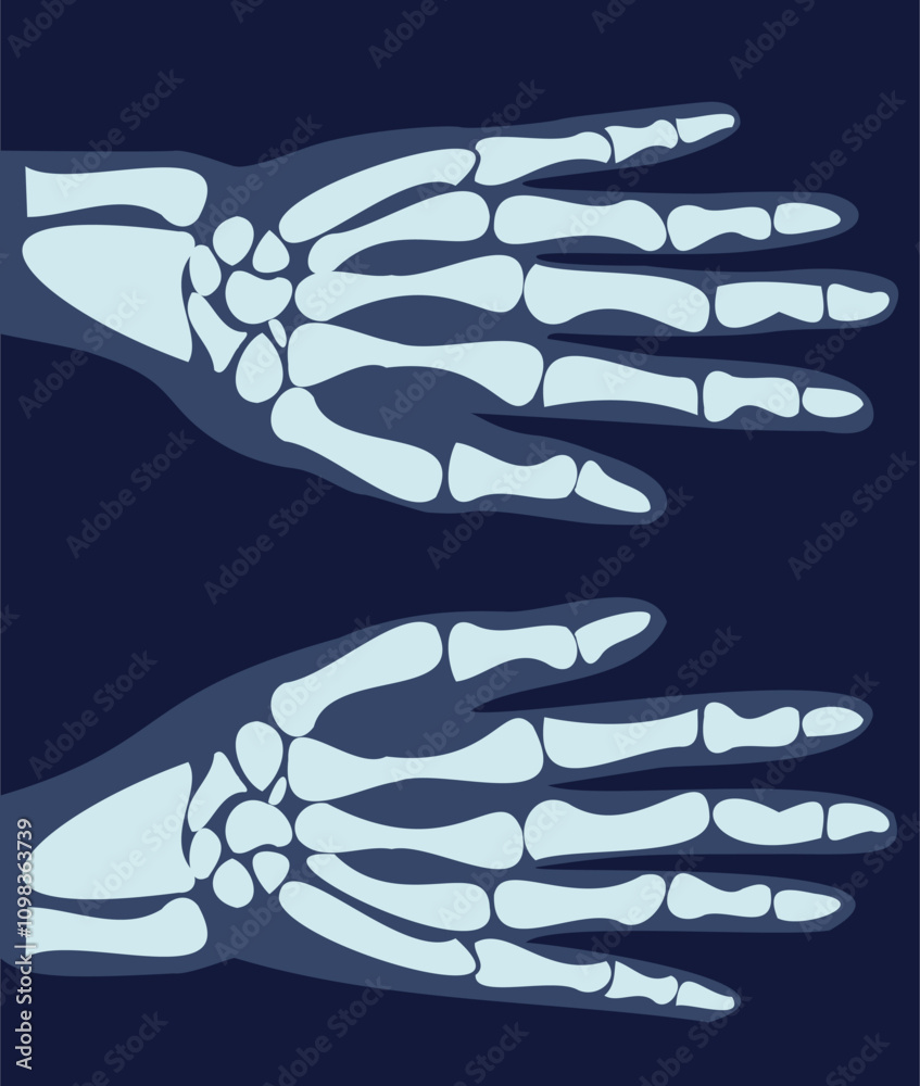 X rays image with bone. Xray of hand and arm. Diagnosis and treatment ...