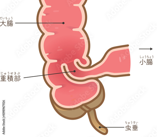 腸重積症、Intussusception、イラスト