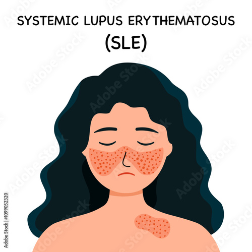 Systemic lupus erythematosus. Girl with the typical butterfly rash in lupus. SLE. skin disease.