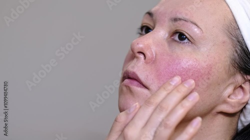 Detailed view of uneven skin with acne and pimples. Facial pores, blemishes, and natural texture. Concept of skin issues, treatments, and care for a healthy appearance.