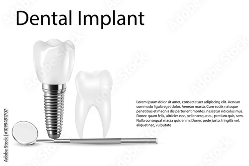 Dental implant structure medical pictorial educative infographic poster with molar replacement end healthy tools models vector illustration.