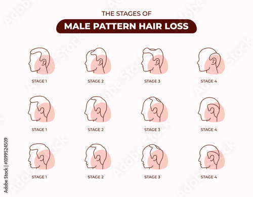 The Stages of Men Hair Loss Line Icon Set,  Hair Follicle, Transplantation, Healthy Hair, Stage, Clinic, Alopecia, Editable Stroke.