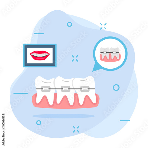 Teeth Aligners or metal wired braces with Before After smile concept, Lingual orthodontic treatment appliances vector design, Dentistry symbol, Healthcare sign, Dental instrument stock illustration