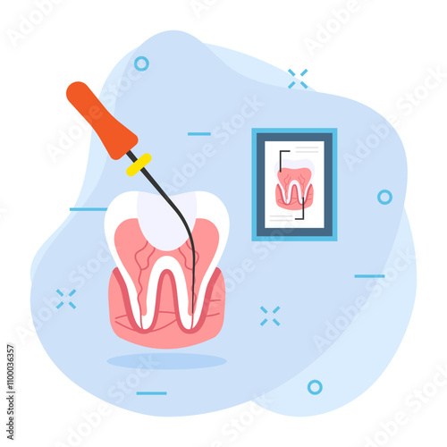 Endodontic therapy Root canal treatment Concept, dental examination with Probe and Repair cavities vector color icon design, Dentistry symbol, Healthcare sign, Dental instrument stock illustration