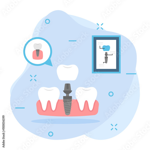 Replacing one Missing Teeth using Dental Implant Concept, permanent fixed dentures replacement vector color icon design, Dentistry symbol, Healthcare sign, Dental instrument stock illustration