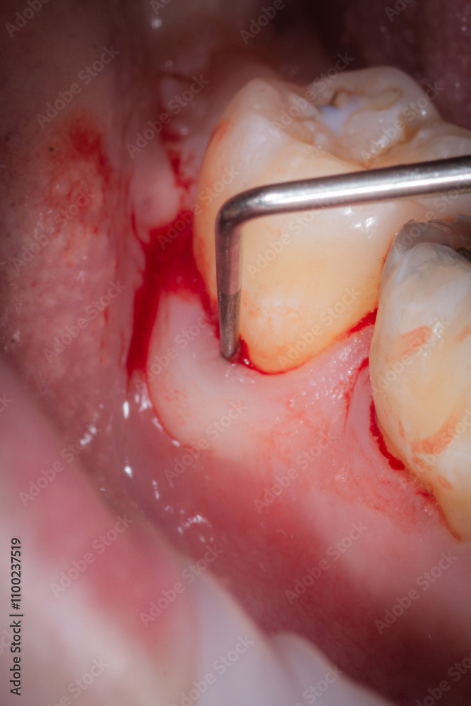 Fototapeta premium Periodontal probing lower molar