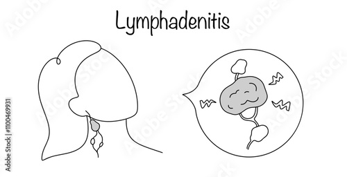 Lymphadenitis photo