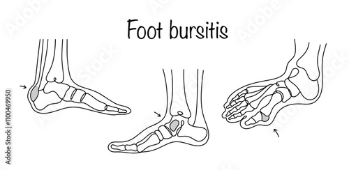 Foot bursitis