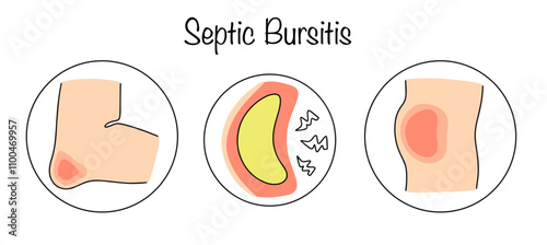 Septic Bursitis