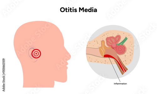 Otitis media inflammation anatomy human ear pain disease medical infographic 