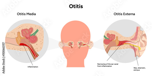 Otitis media and externa inflammation anatomy human ear pain disease medical infographic 