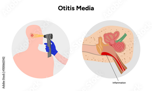 Otitis media inflammation anatomy human ear pain disease medical infographic and check up in doctor appointment 