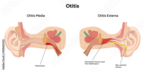 Otitis media and externa inflammation anatomy human ear pain disease medical infographic 