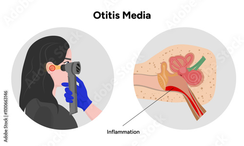 Otitis media inflammation anatomy human ear pain disease medical infographic and check up in doctor appointment 