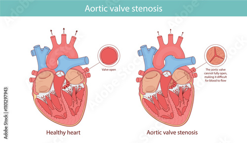A medical illustration shows the difference between a normal artis valve and a stenotic valve. Illustration in cartoon style