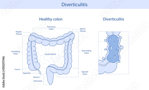Intestinal diverticulitis. anatomical illustration of the rectum, appendix, small intestine in cartoon style.