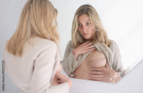Woman examines herself in the mirror, showing the early stages of breast reconstruction after a mastectomy due to breast cancer