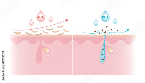 Alpha Hydroxy Acids and Beta Hydroxy Acids characteristics vector illustration on white background. AHA exfoliate the surface skin and water soluble. BHA penetrate deep into the pore and oil soluble.