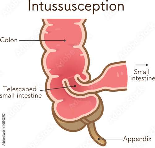 腸重積症、Intussusception、イラスト photo