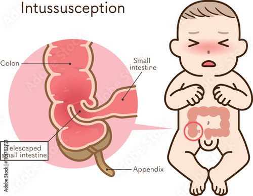 腸重積症、Intussusception、イラスト