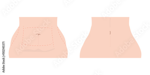 Liposuction, plastic surgery, before and after. Fat belly and slim waist. Aesthetic body transformation, weight loss in waistline, abdomen. Flat vector illustration isolated on white background