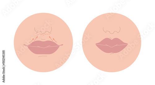 Lip augmentation procedure, plastic surgery. Before and after cosmetic shaping with filler for big volume. Aesthetic reshaping, correction. Flat vector illustration isolated on white background