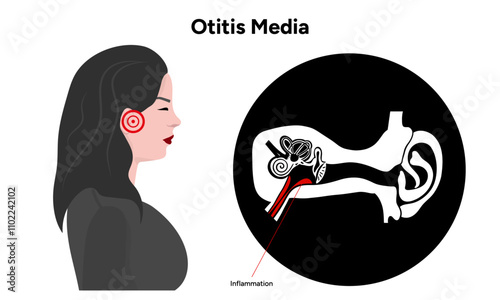 Otitis media inflammation anatomy human ear pain disease medical infographic and check up in doctor appointment 