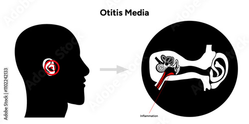 Otitis media inflammation anatomy human ear pain disease medical infographic 