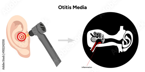 Otitis media inflammation anatomy human ear pain disease medical infographic and check up in doctor appointment 