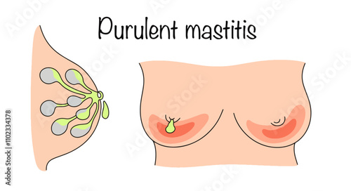 Purulent mastitis