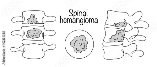 Spinal hemangioma